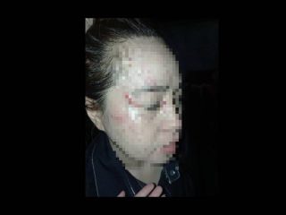 Diduga Dianiaya Istri Siri Oknum Polisi, Perempuan di Butur Alami Luka di Wajah